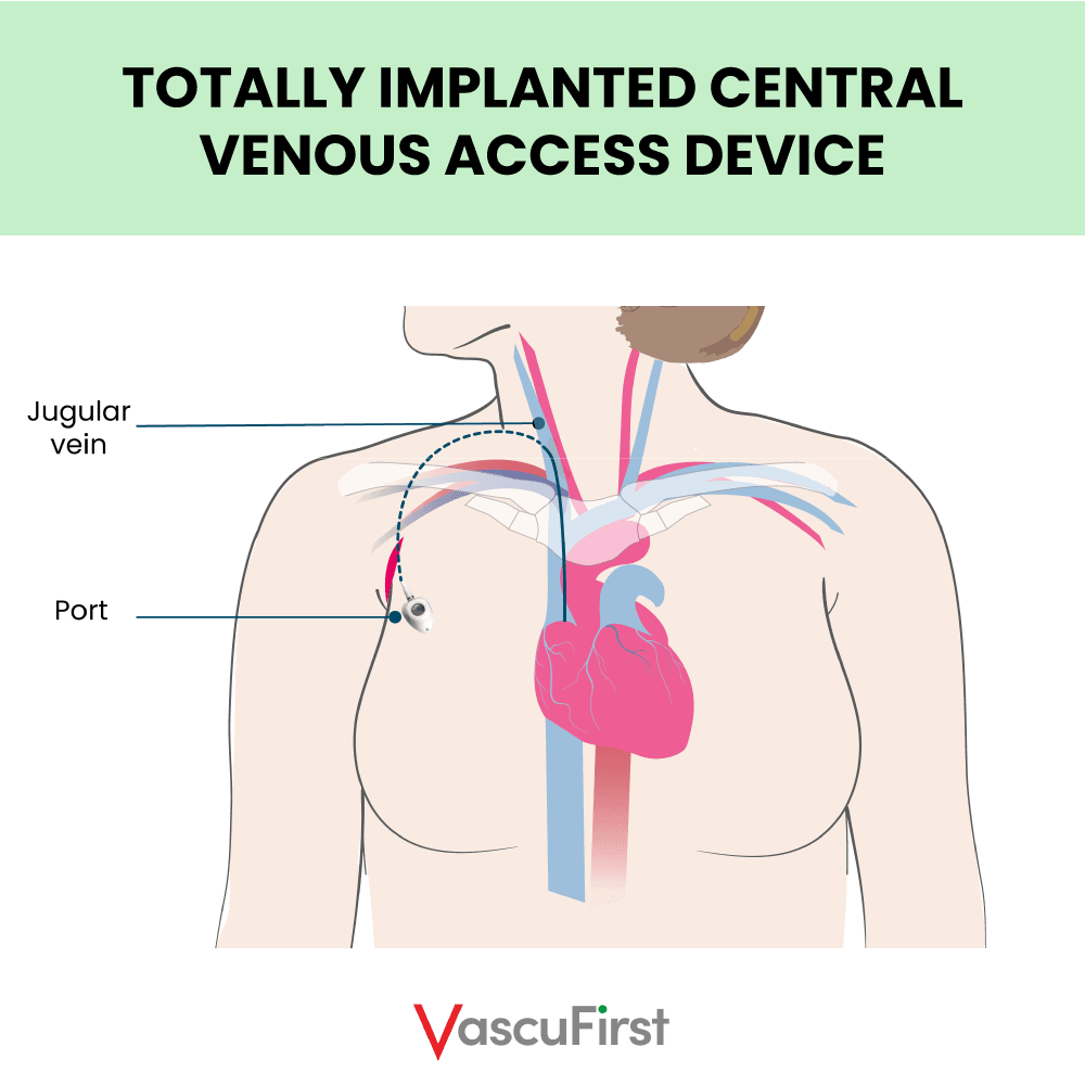 Understanding Chest and Neck Veins for Vascular Access: A Comprehensive Overview, by Dr Linda Kelly Understanding Chest and Neck Veins for Vascular Access: A Comprehensive Overview, by Dr Linda Kelly